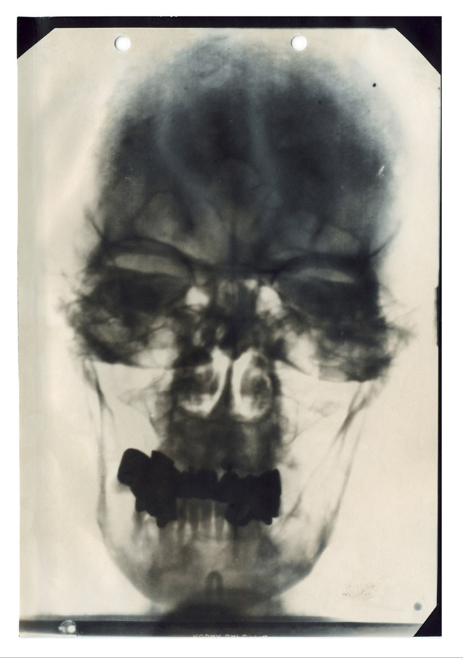 Hitler Medical Head X-ray